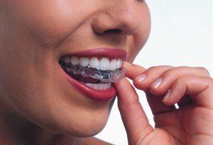 Misconceptions about invisalign